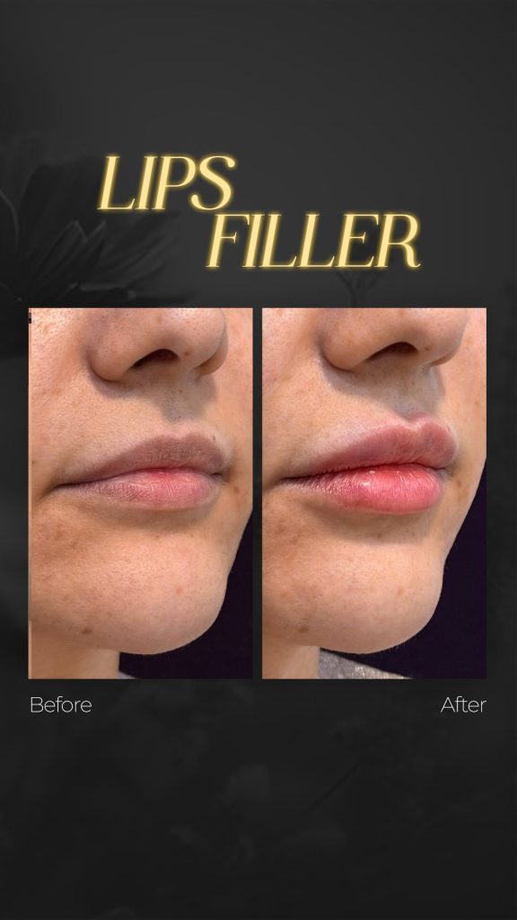 Dr. Soheila Eskandari — Before/After Lip Filler — video reel cover